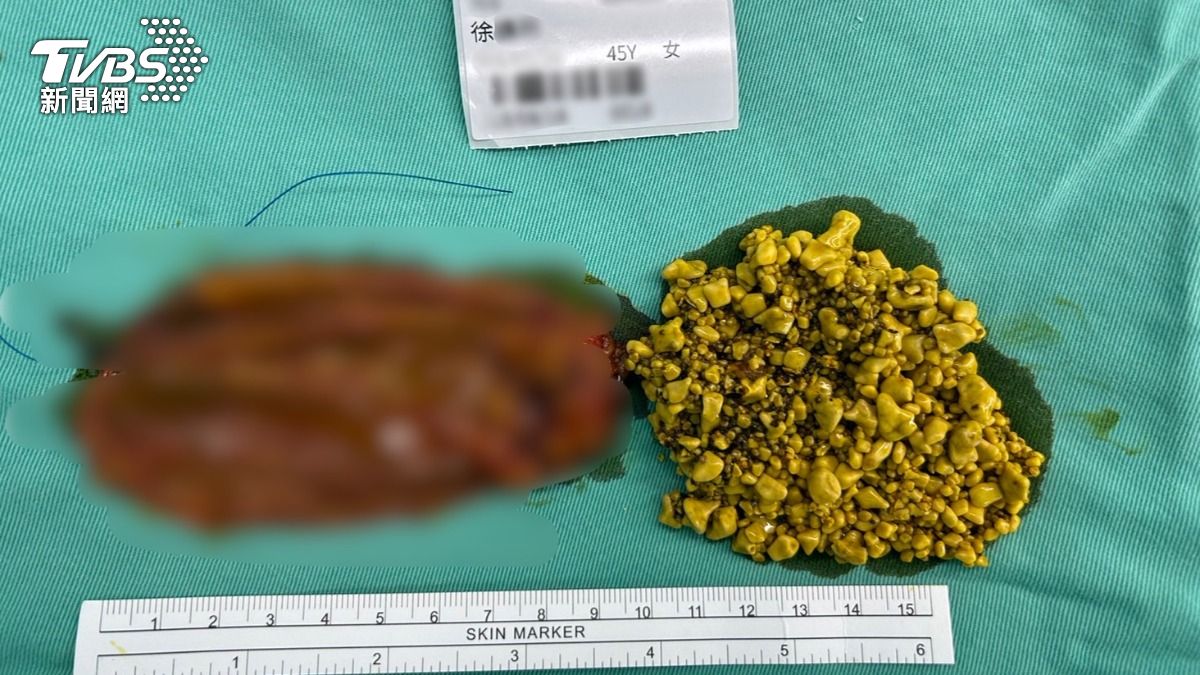 女工程師胃悶!一照赫見「3千顆膽結石」 多到拼成甲骨文