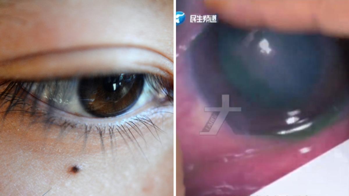 陸大媽路邊攤點痣完「眼角膜燒傷」 痛喊:想把眼球挖出来