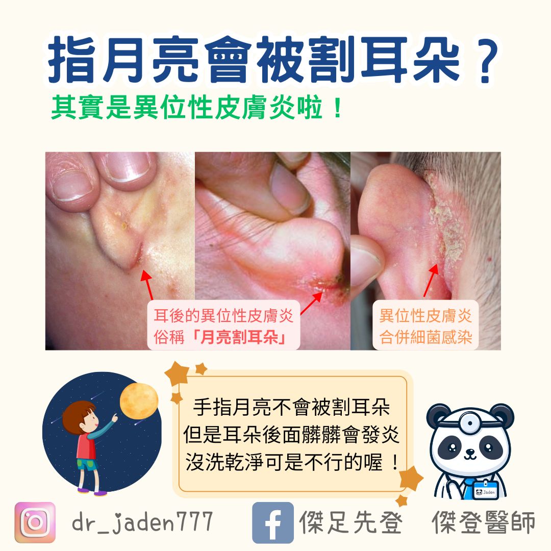 醫師破解「指月亮被割耳朵」傳說。(圖/翻攝自傑足先登 傑登醫師臉書)