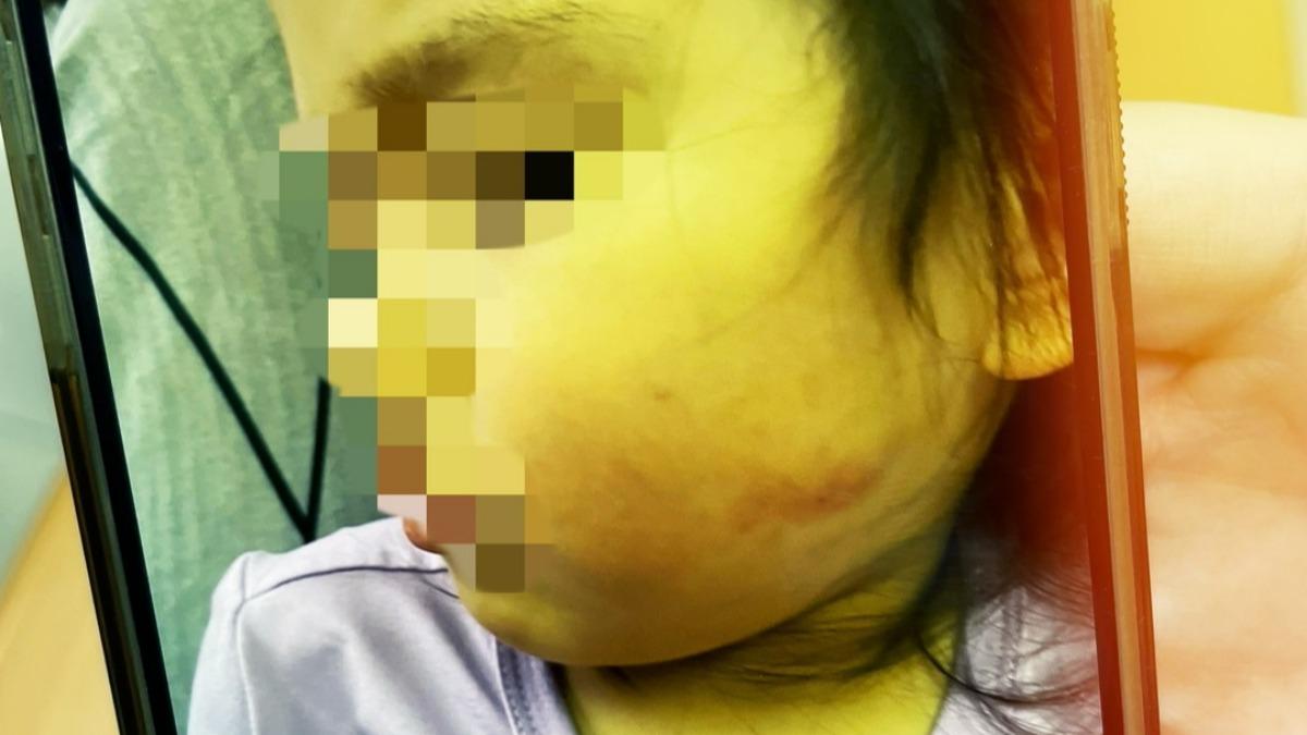 女童小小的臉蛋紅腫，還帶著血跡。（圖／黃瓊慧議員提供）