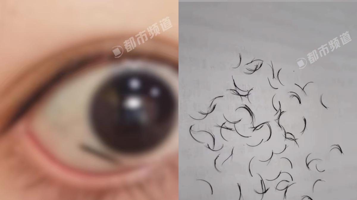 女子眼睛裡有一大撮眼睫毛,總共有74根。(圖/翻攝自微博)