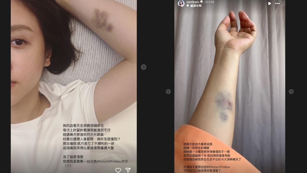 吳姍儒的手臂留有大片瘀血,讓她痛到大哭。(圖/翻攝自吳姍儒IG)