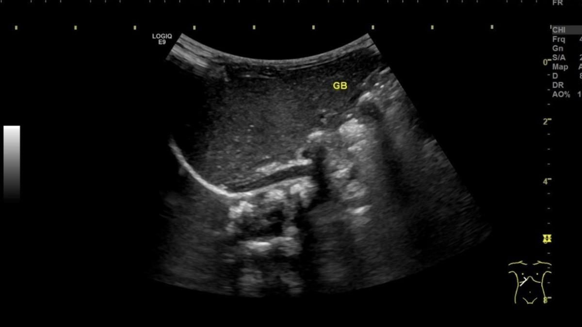 突拉白色便便!台中2週大女嬰患「萬分之2疾病」 膽汁卡肝恐硬化