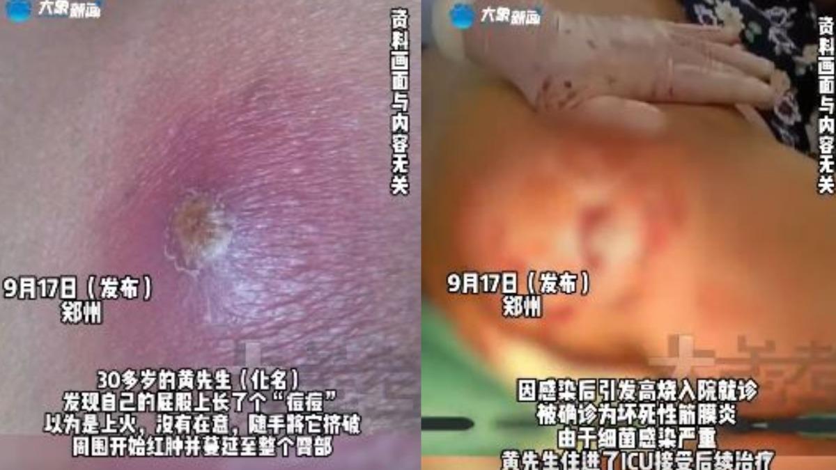 「癤」與一般痘痘外觀非常相似,但若隨意擠壓恐有生命危險。(圖/翻攝自微博)