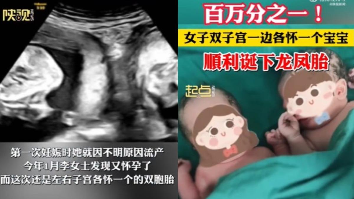 左右都懷了!陸女極罕見雙子宮 百萬分之1機率「生下龍鳳胎」