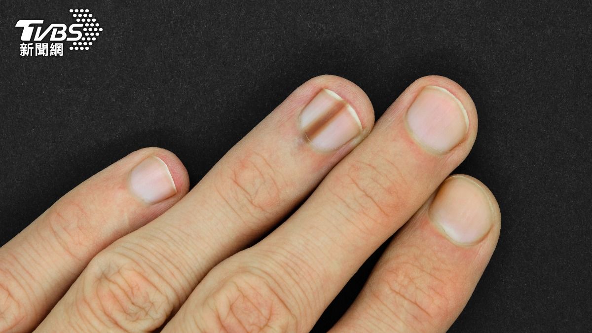 7旬老婦「指甲黑黑的」消極就醫！一查慘中皮膚癌王　死亡率極高