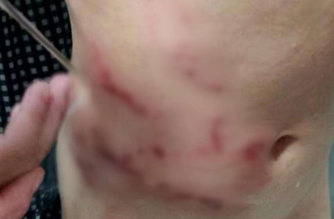 3歲女童慘遭撕肉，傷口噴血。（圖／翻攝自微博）