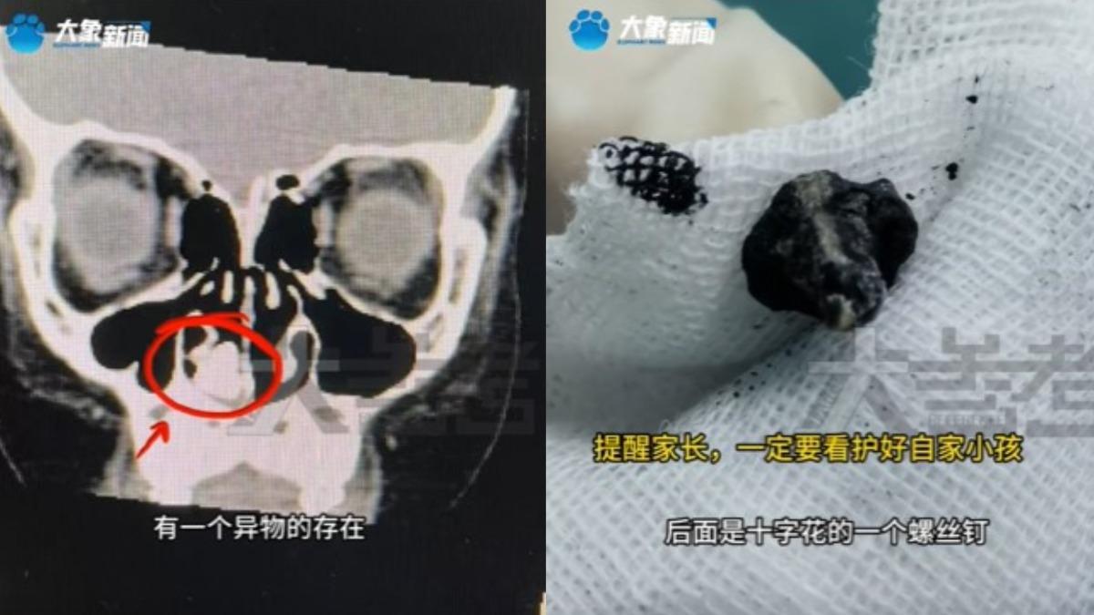 飄惡臭2年！7歲陸童鼻突流膿　「挖出生鏽螺絲釘」家長看傻