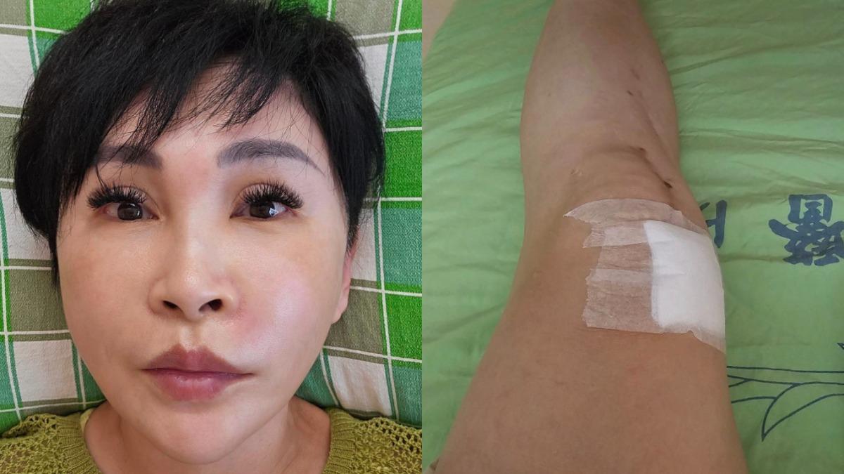 臉頰摸到硬塊!資深名嘴病情惡化「狂流膿」 蜂窩性組織炎急住院