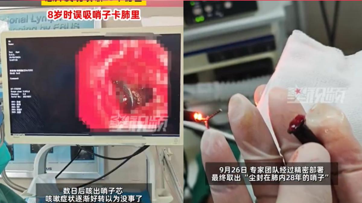 反覆咳嗽沒好!陸男搭巴士遇追撞 送醫驚見哨子卡肺部28年