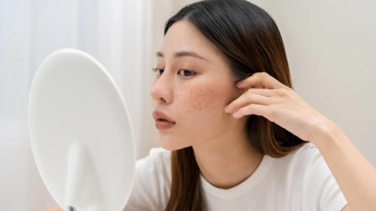 臉上有較多痘痘、斑點或細紋別染淺。(示意圖/shutterstock達志影像)