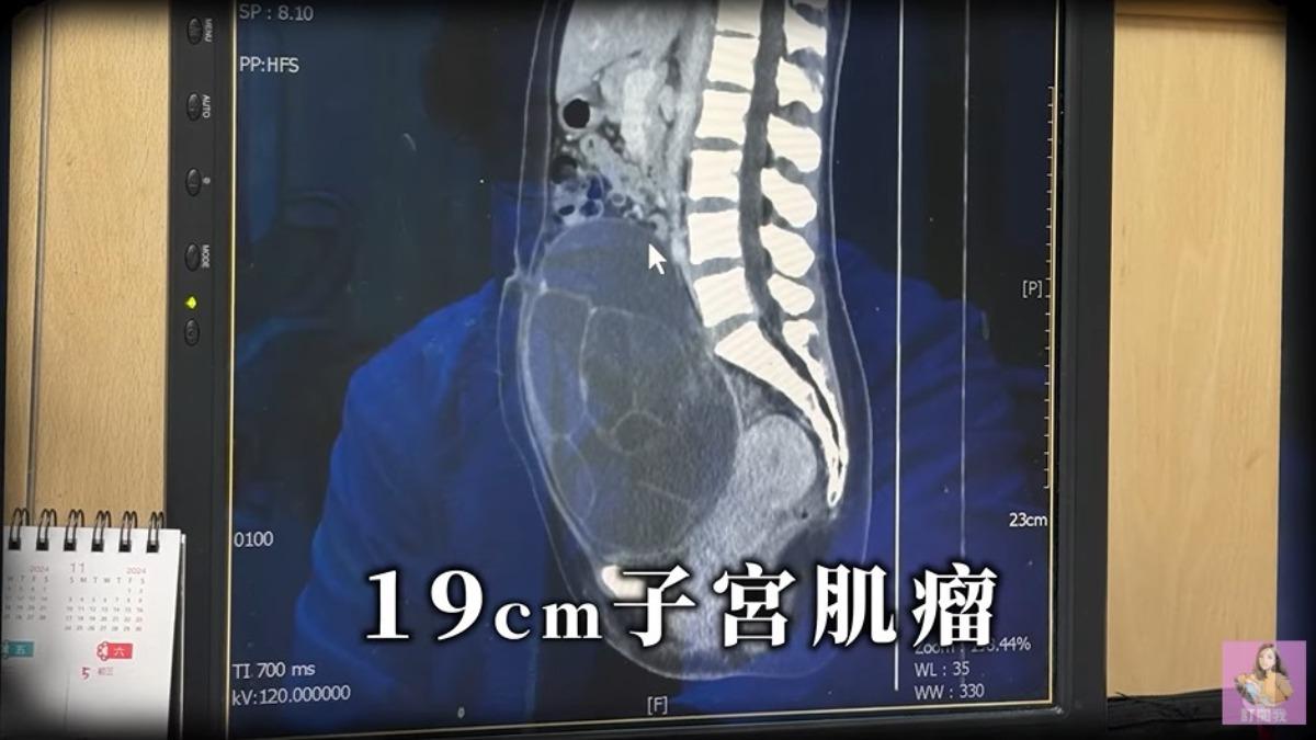 江老師公開腹部超音波,腫瘤大得驚人。(圖/翻攝自我是江老師YouTube)