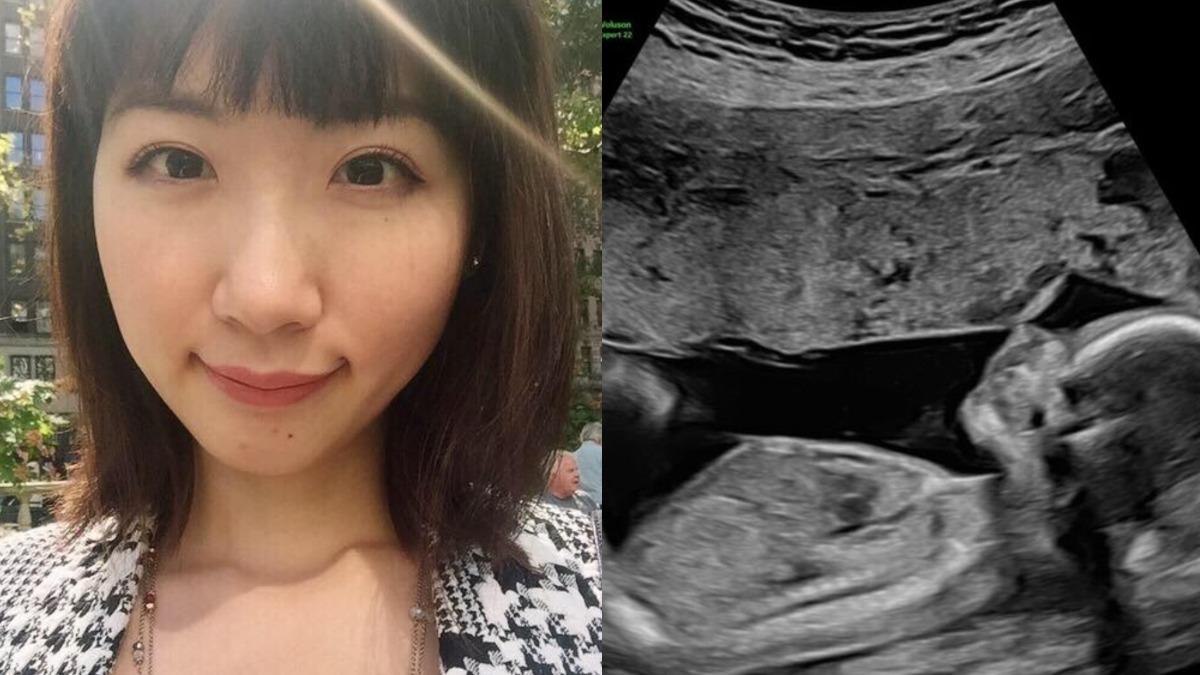 廣告小妹流產3年！今宣布懷孕喜訊　曬超音波照淚喊：小聰回來了
