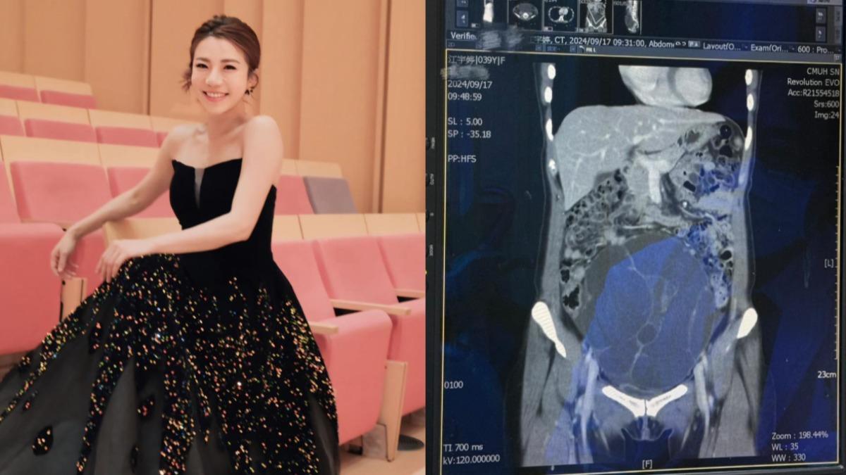 2症狀拖2年!網紅一照竟長「19cm巨瘤」 塞滿整個子宮