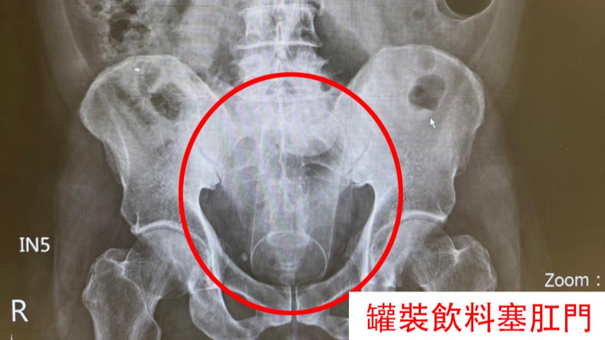男子肛門塞了一瓶罐裝飲料。(圖/中國醫藥大學新竹附設醫院提供)