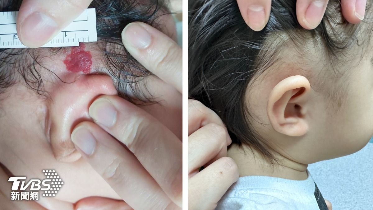不是胎記!台中女童耳後凸起紅色斑塊 醫一查大驚:血管瘤