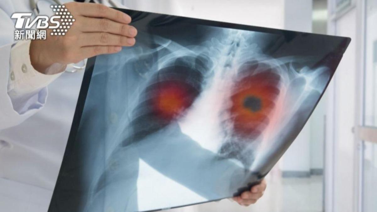 汪建民肺腺癌亡!近5成患者未吸菸 星研究:炒菜油煙也傷肺