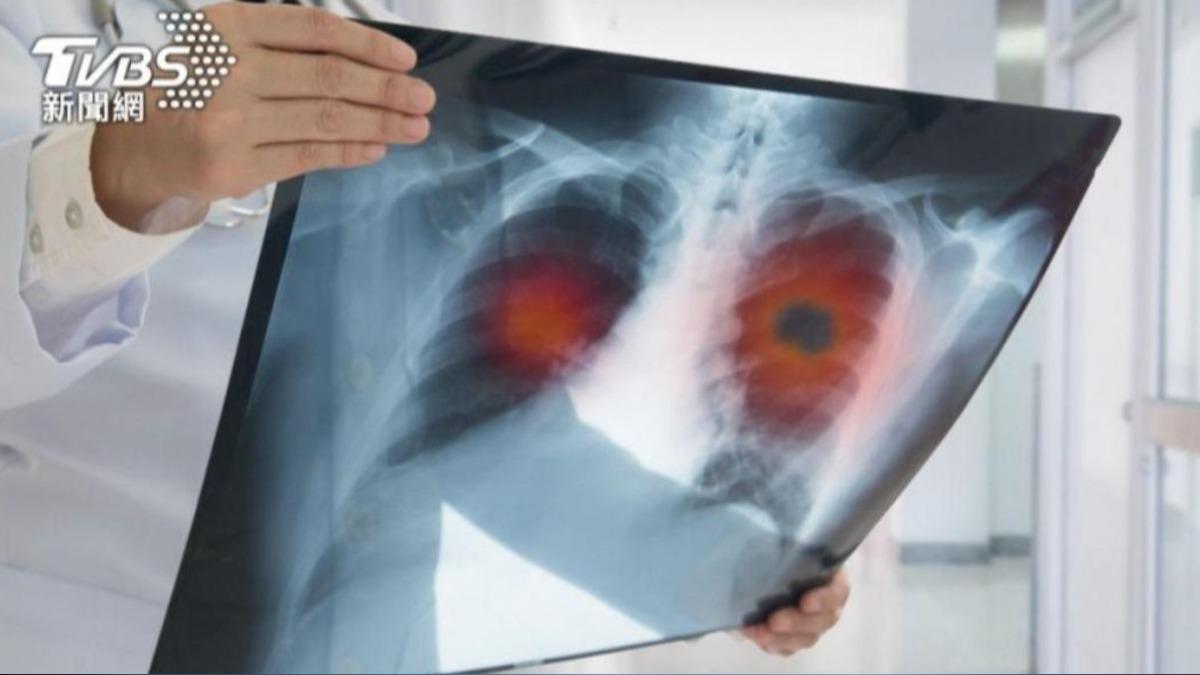 不菸不酒竟肺癌!50歲男「腫瘤6cm」 醫揭台人基因1關鍵