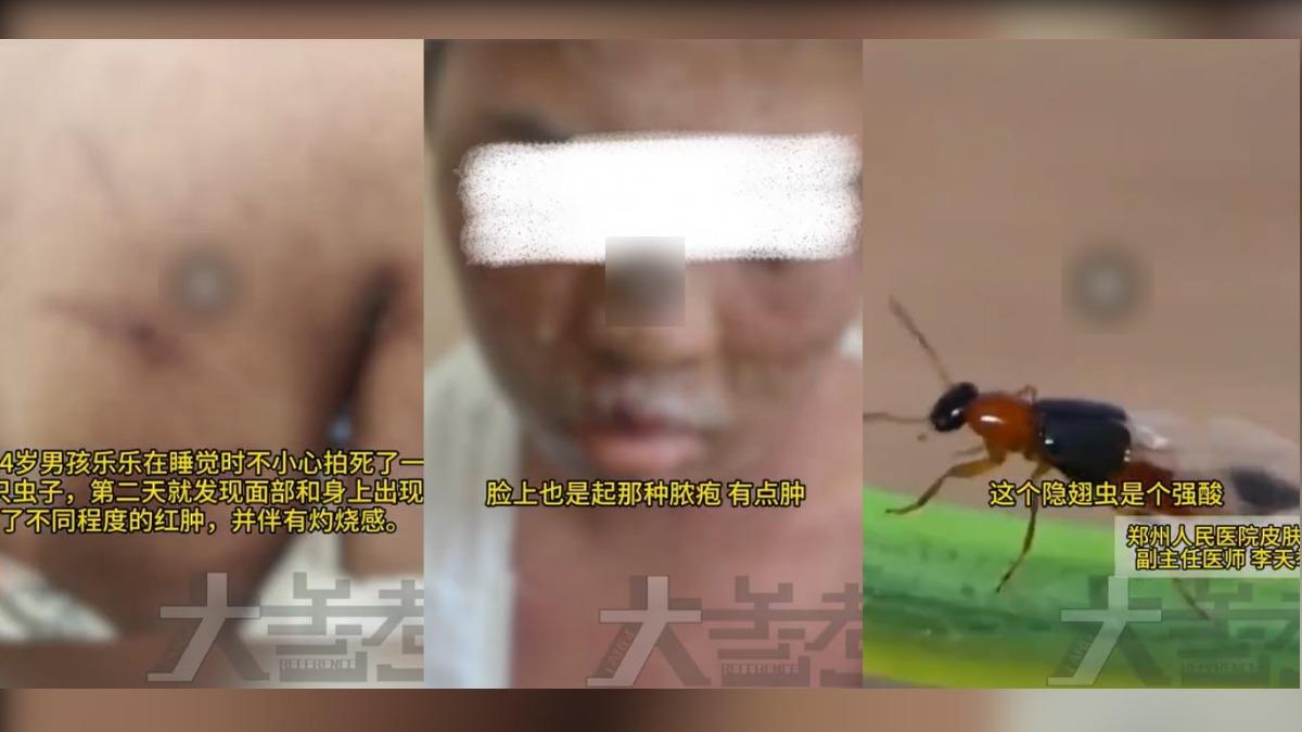 14歲少年拍死隱翅蟲後全身潰爛。（圖／翻攝自 陸媒）