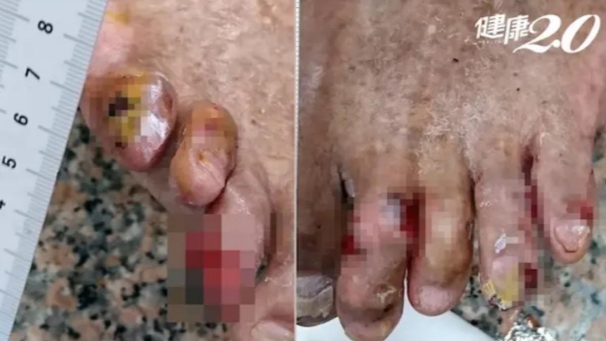 9旬翁患糖尿病疑「遭老鼠啃咬」 雙腳多處傷口滲血竟無感