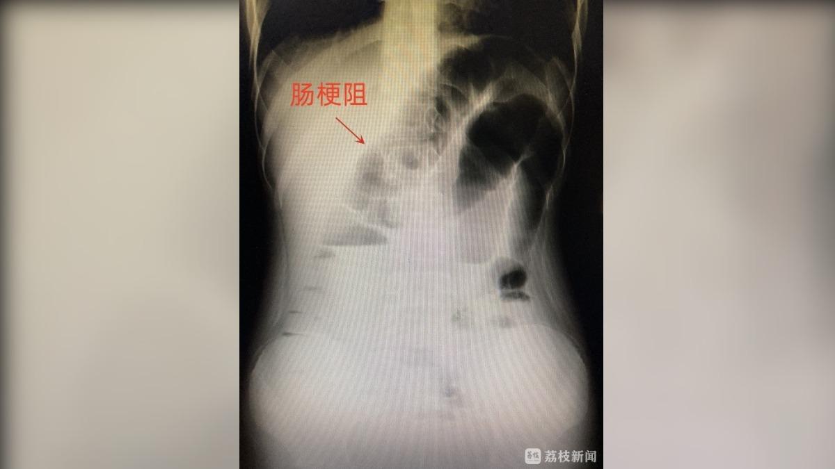 女童吃進的瓜子全堵住直腸。(圖/荔枝新聞)