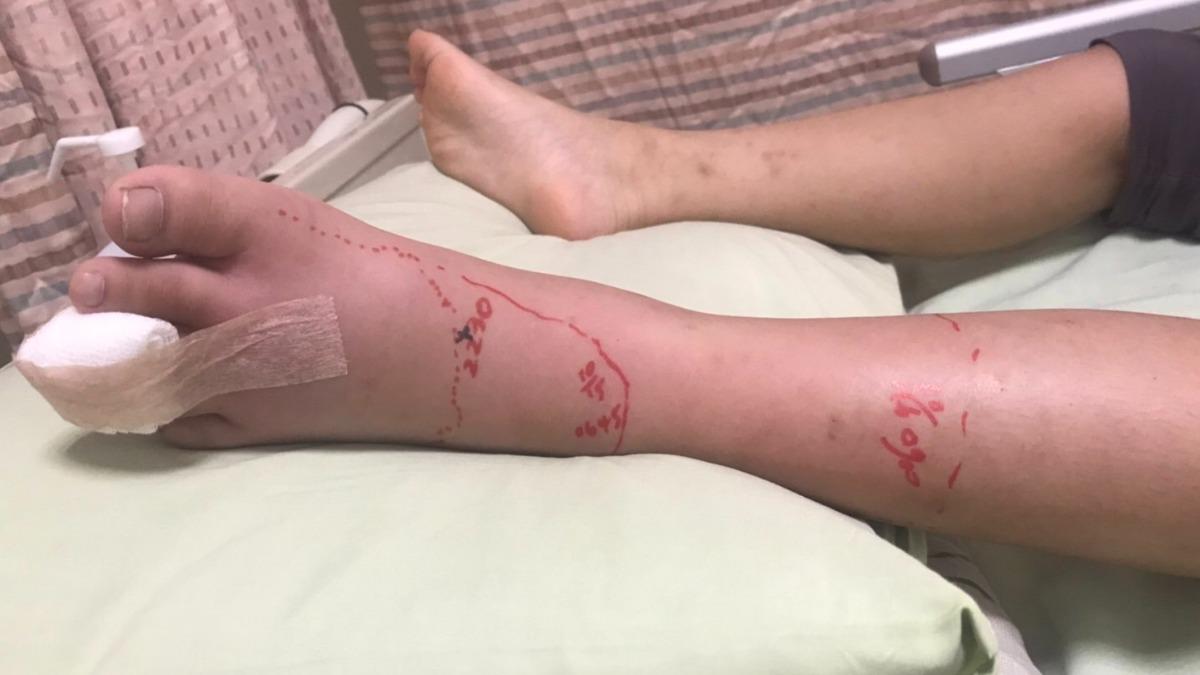 全校警戒!颱風過境蛇出沒 高雄男童倒垃圾遭咬「腳腫成麵龜」