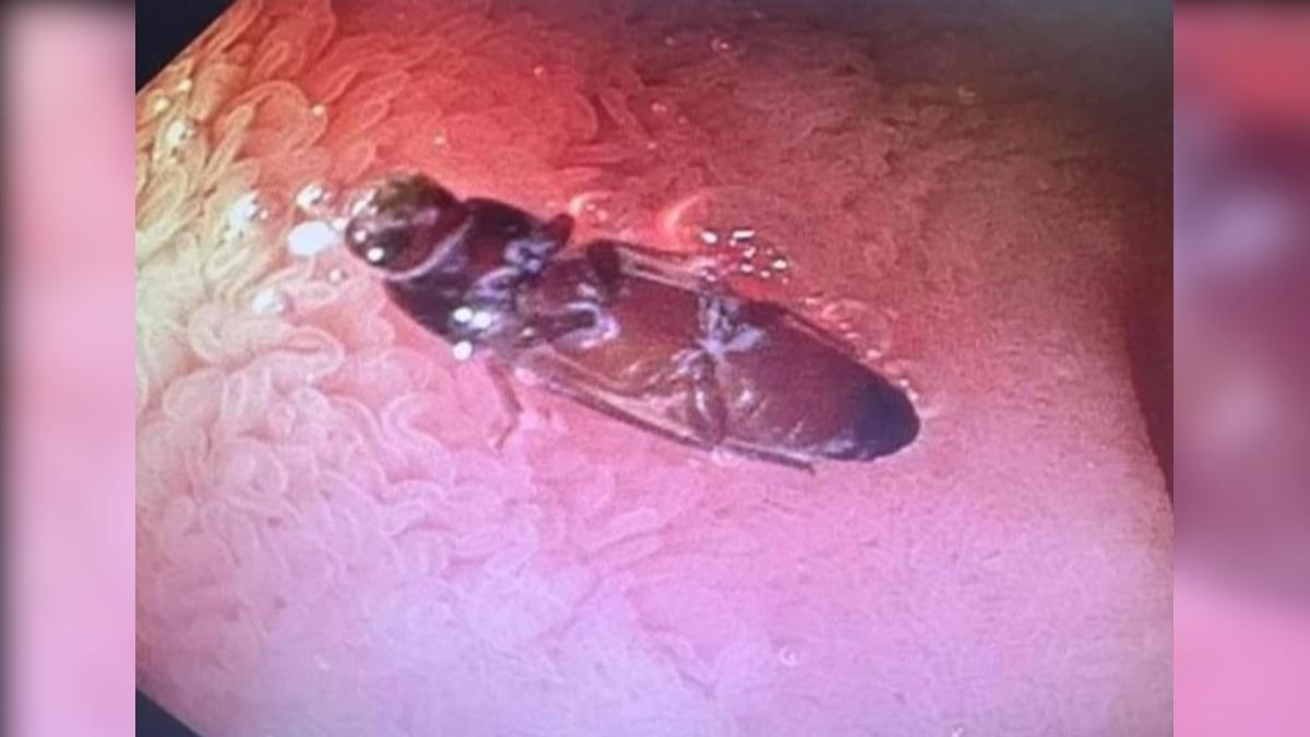 醫生進行上消化道的內視鏡檢查後,發現男子的小腸道裡有隻3公分長的蟑螂。(圖/翻攝自Oddity Central)