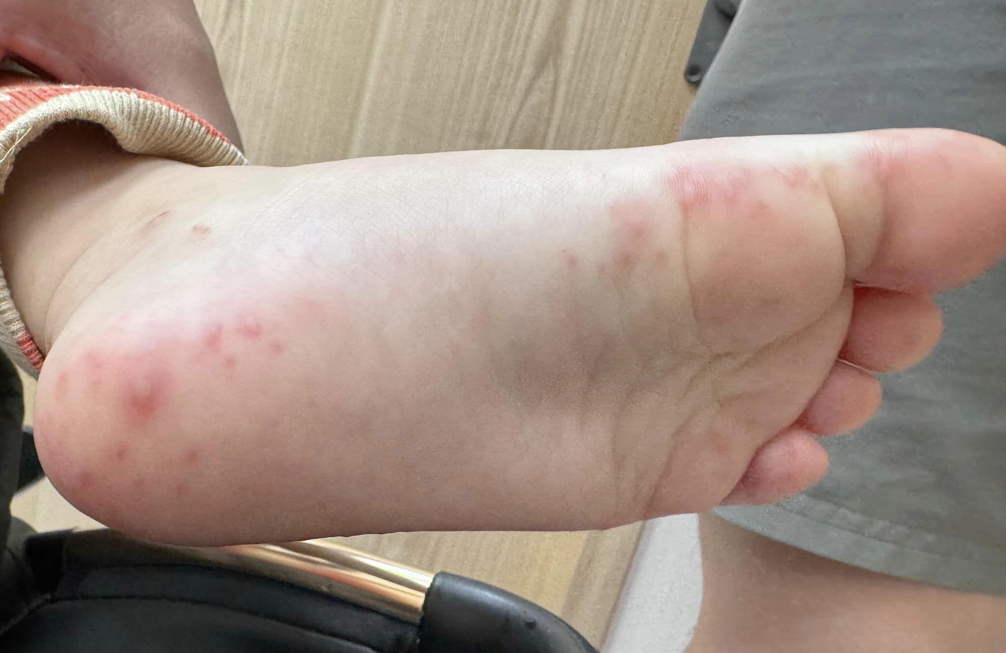 顏俊宇醫師分享小孩因為染上腸病毒，手腳出現紅疹或小水泡。（圖／翻攝自「寶爸的小宇宙｜兒童感染科 顏俊宇醫師」臉書）