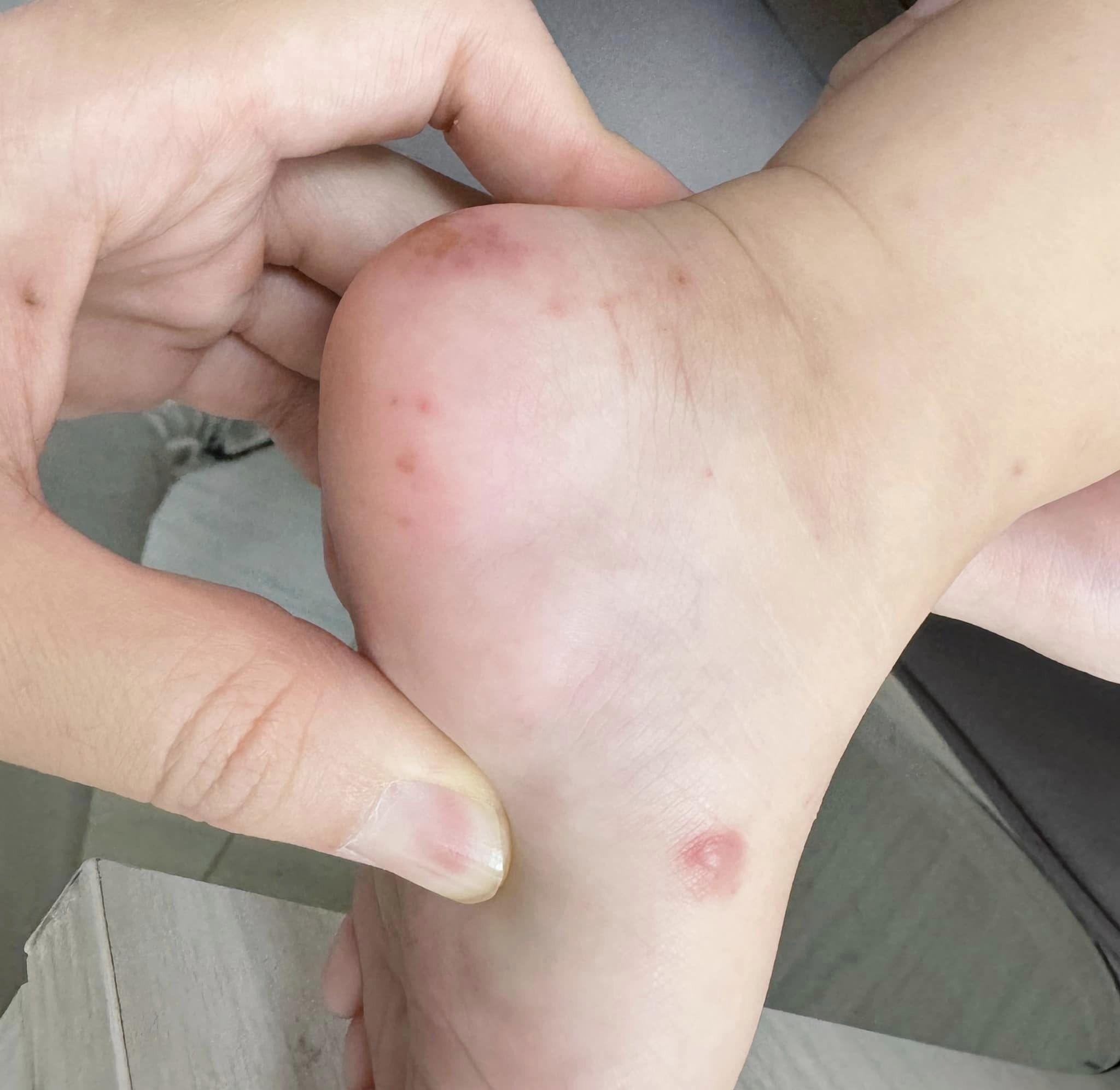 顏俊宇醫師分享小孩因為染上腸病毒，手腳出現紅疹或小水泡。（圖／翻攝自「寶爸的小宇宙｜兒童感染科 顏俊宇醫師」臉書）