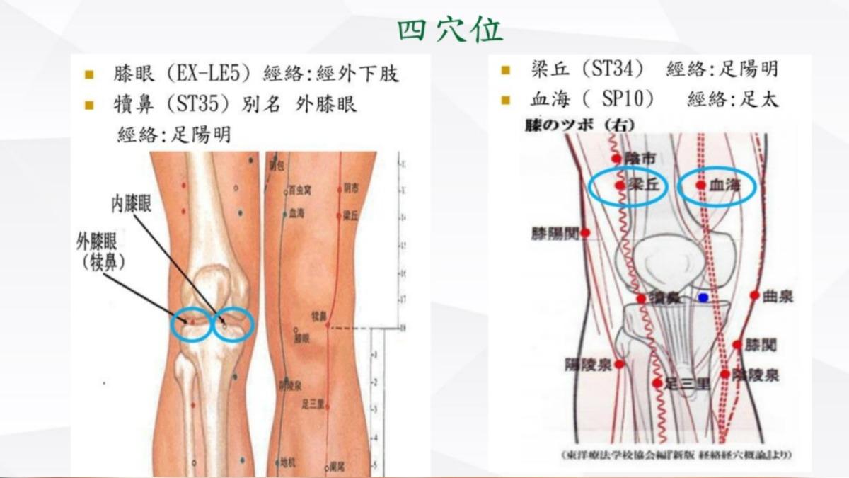 針灸四穴位膝蓋不再痛。（圖／蔡曜鍵醫師提供）