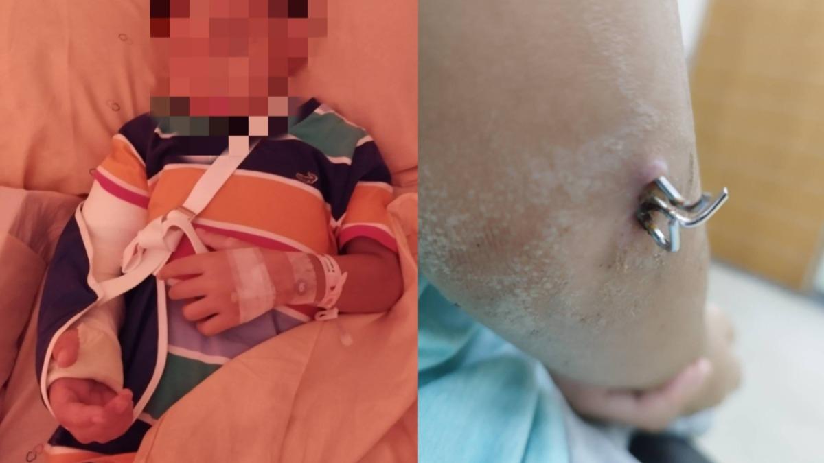 男童幼兒園摔斷手!監視器故障「畫面全消失」 嘉義縣府回應了