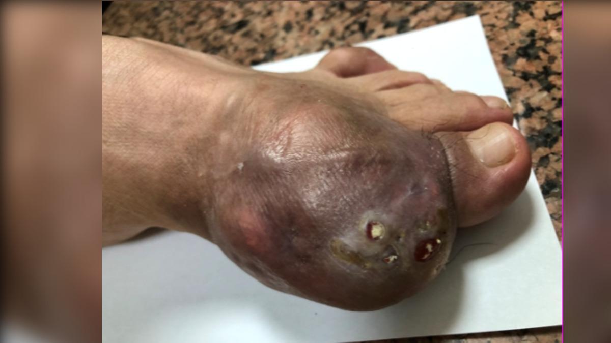 輕忽「帝王病」!台中翁腳成恐怖腫球 醫:3解方皆需長期吃藥