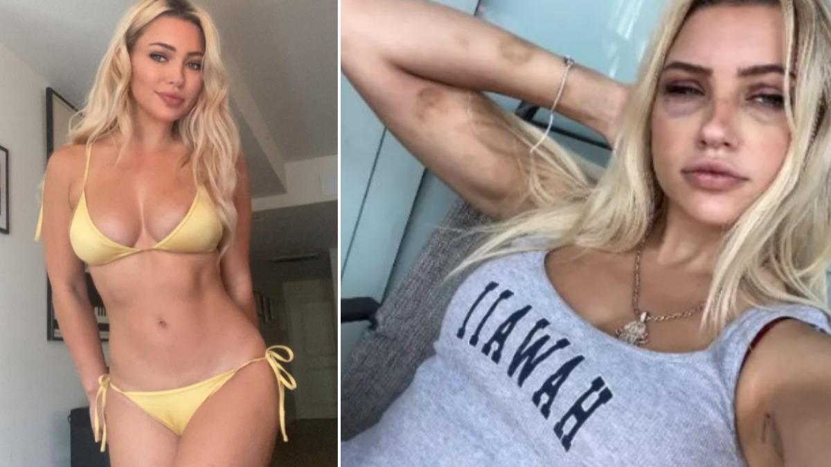 希亞斯在交往期間身體和臉佈滿血跡與瘀傷。(圖/翻攝自 IG willowwbarbie、X nypost)