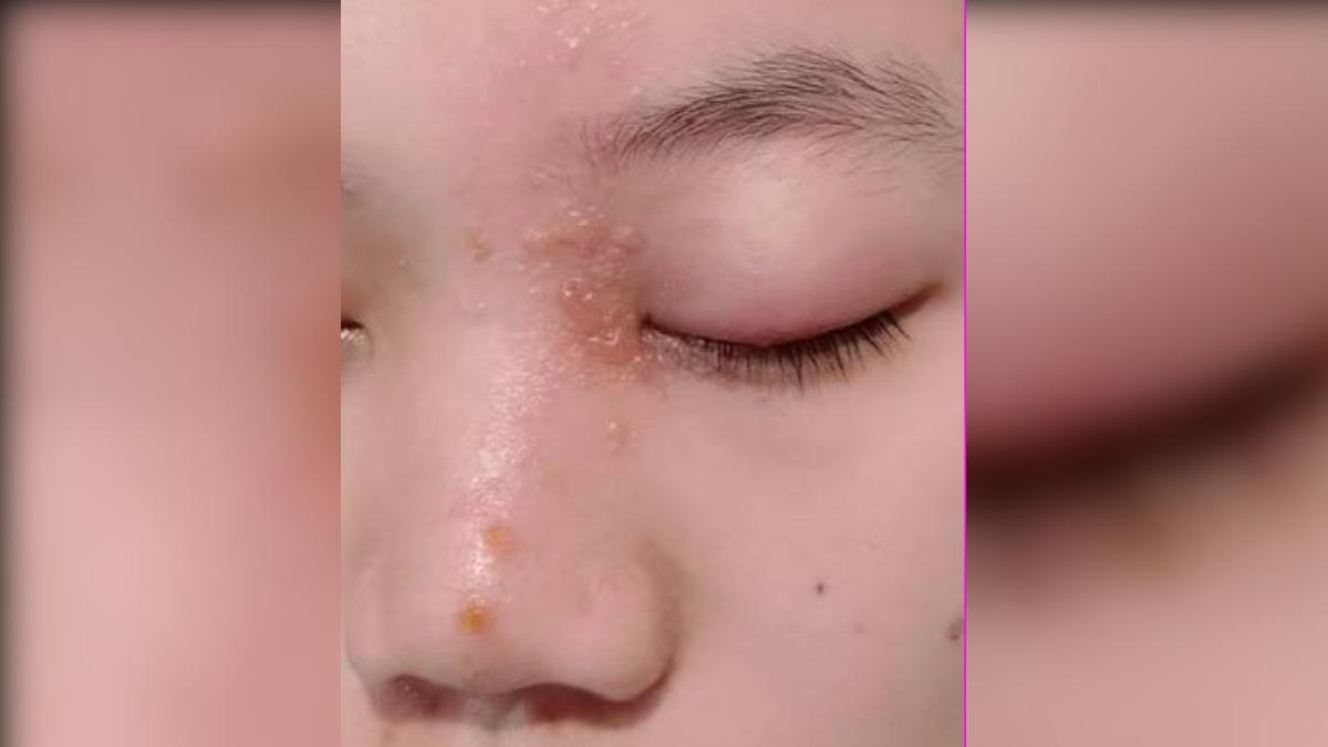 陸女網購拆包裹「1動作」感染疱疹 醫師揭:痛度超越分娩