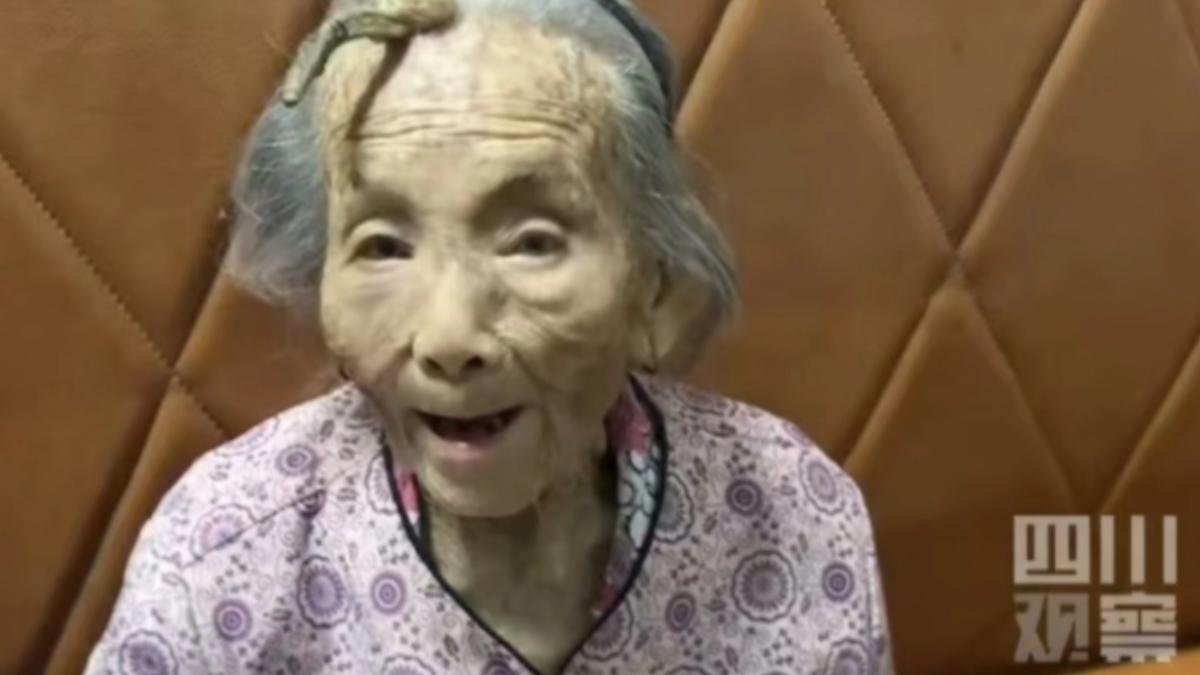 107歲老奶奶額頭長角!兒孫驚呼「長壽角」 醫搖頭:是疾病