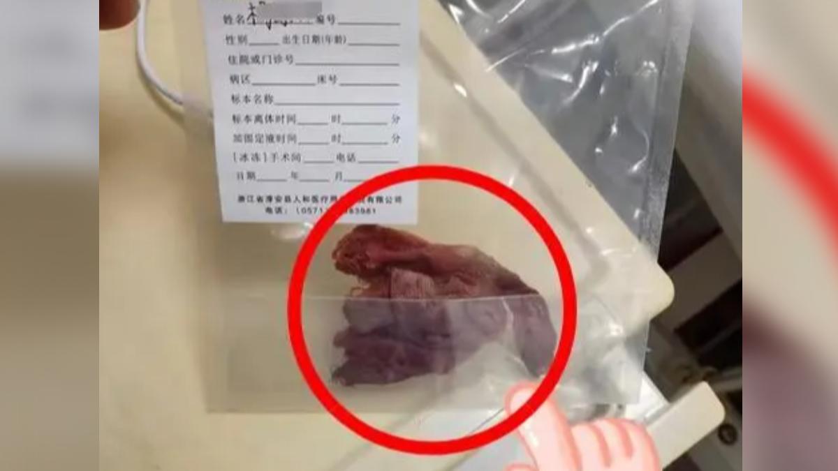 4年前手術紗布未取 47歲陸女腹痛3年「輸卵管遭切」成殘疾