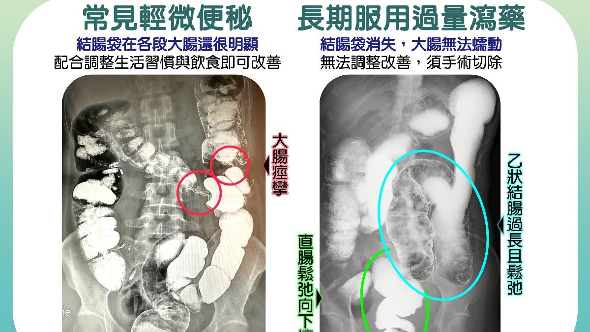 長期過量服用瀉藥的腸道變化,結腸袋消失,無法蠕動,須靠手術解決。(圖/慈濟醫院提供)