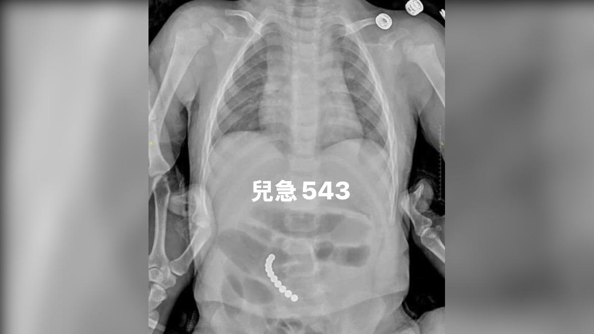 1歲童嘔吐!一照「腹藏10白點」腸破了 母嚇暈:不敢再給孩玩