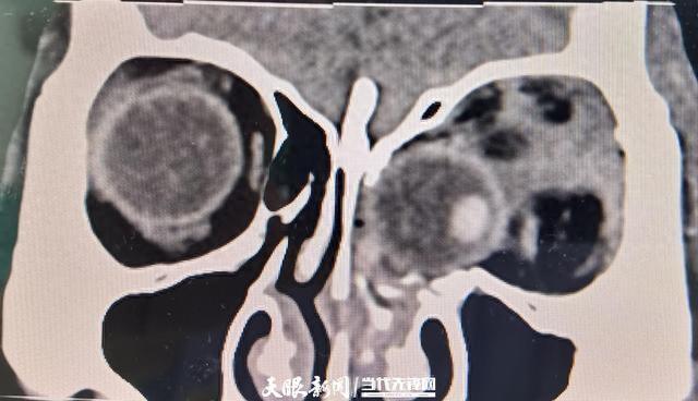 黃姓婦人的左眼球卡進鼻腔內。（圖／翻攝自微博）