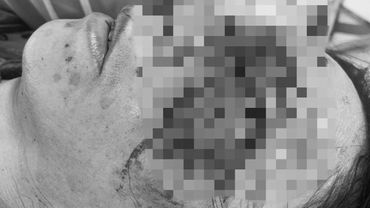 陸50歲婦人樓梯踩空墜3樓!「眼球變形掉鼻腔」卡住 驚悚畫面曝