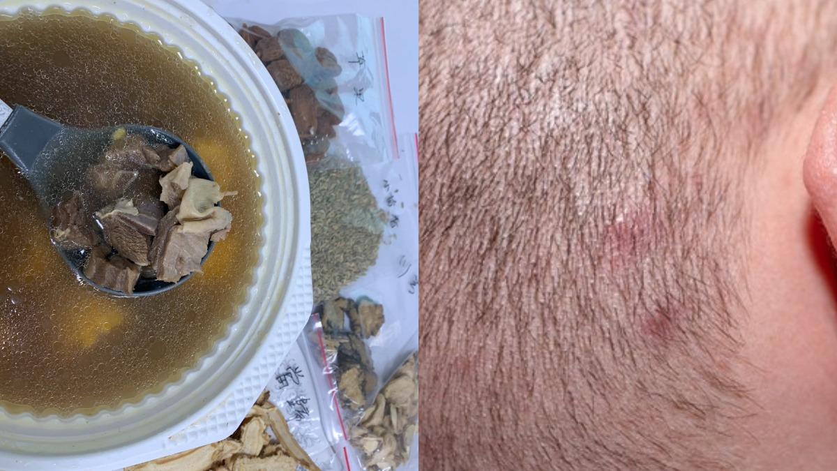 立冬到!中年男連嗑3天羊肉爐 「脖、頭皮」炸痘5類人高風險