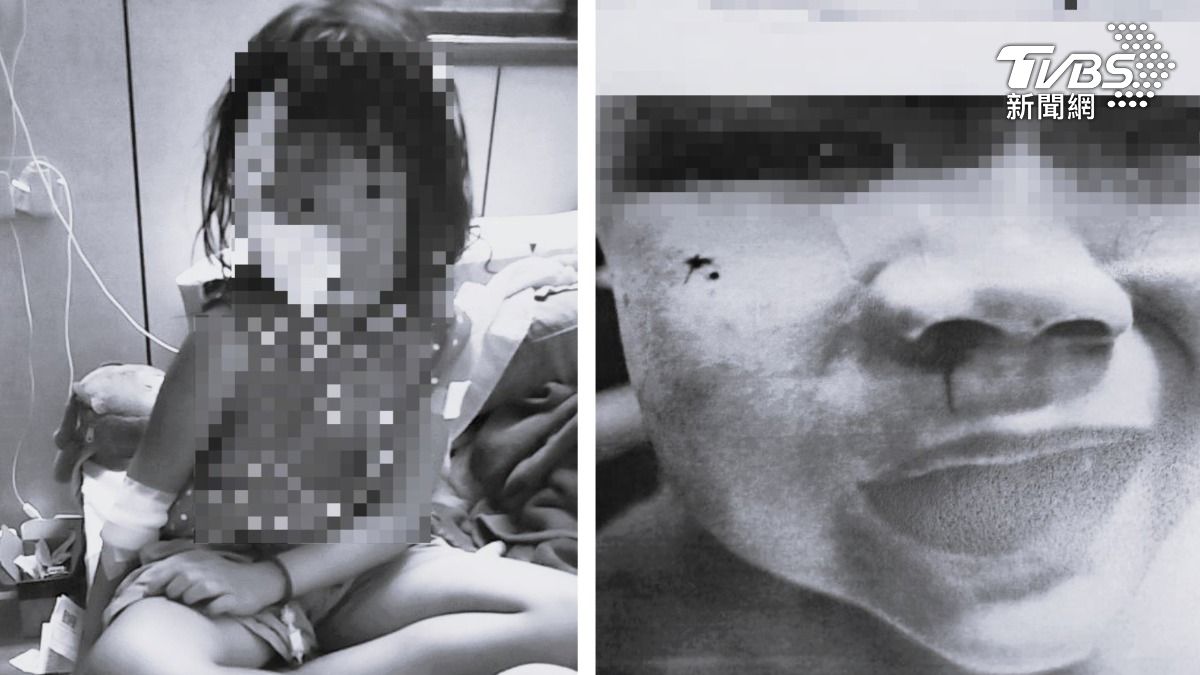 鄰居家秋田犬撲咬!雲林7歲女童頭破血流 上藥痛到放聲大哭