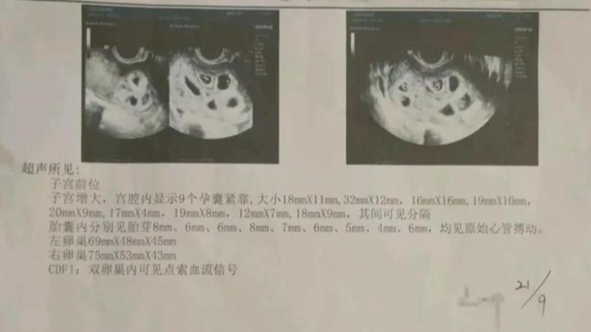 渴望當媽…25歲女一次懷「9胞胎」！夫妻產檢全震驚　醫也慌了