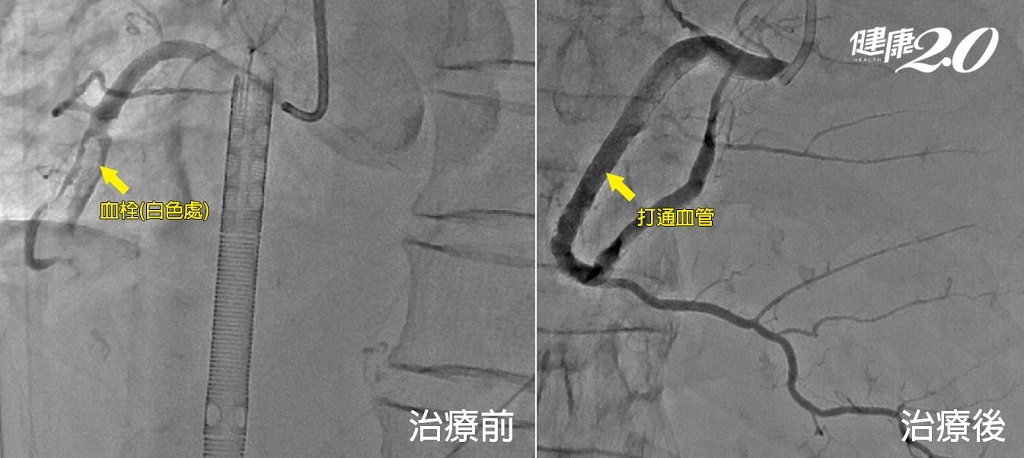 心導管治療前後之影像圖。(圖/澄清綜合醫院中港分院提供)