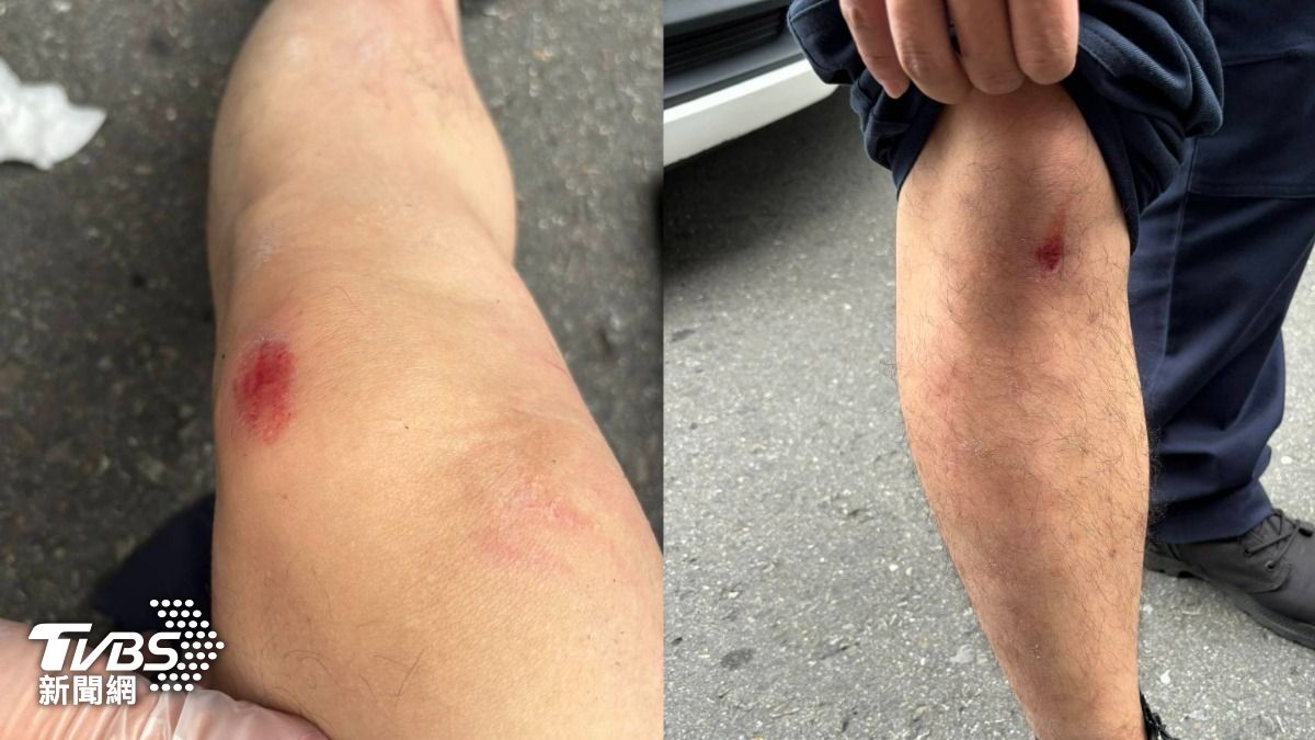 左腳與右腳擦挫傷,所幸意識清楚,送醫後無大礙。(圖/TVBS)