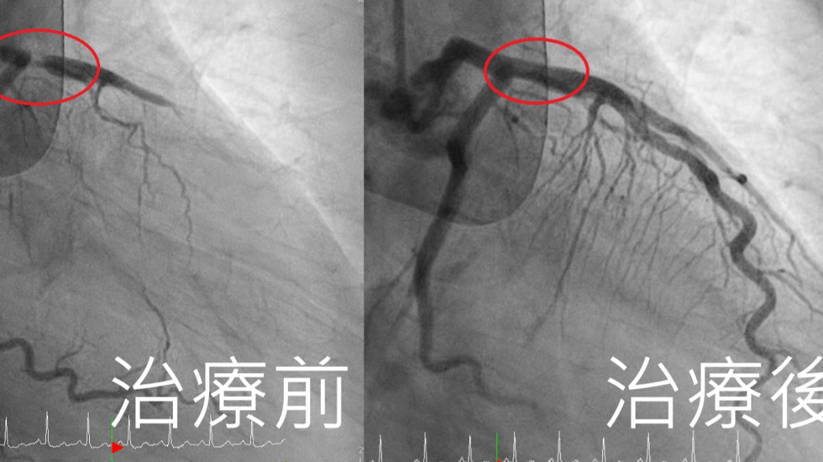 有片/生死瞬間!男離奇昏厥電擊5次回魂 一看動脈99%塞住