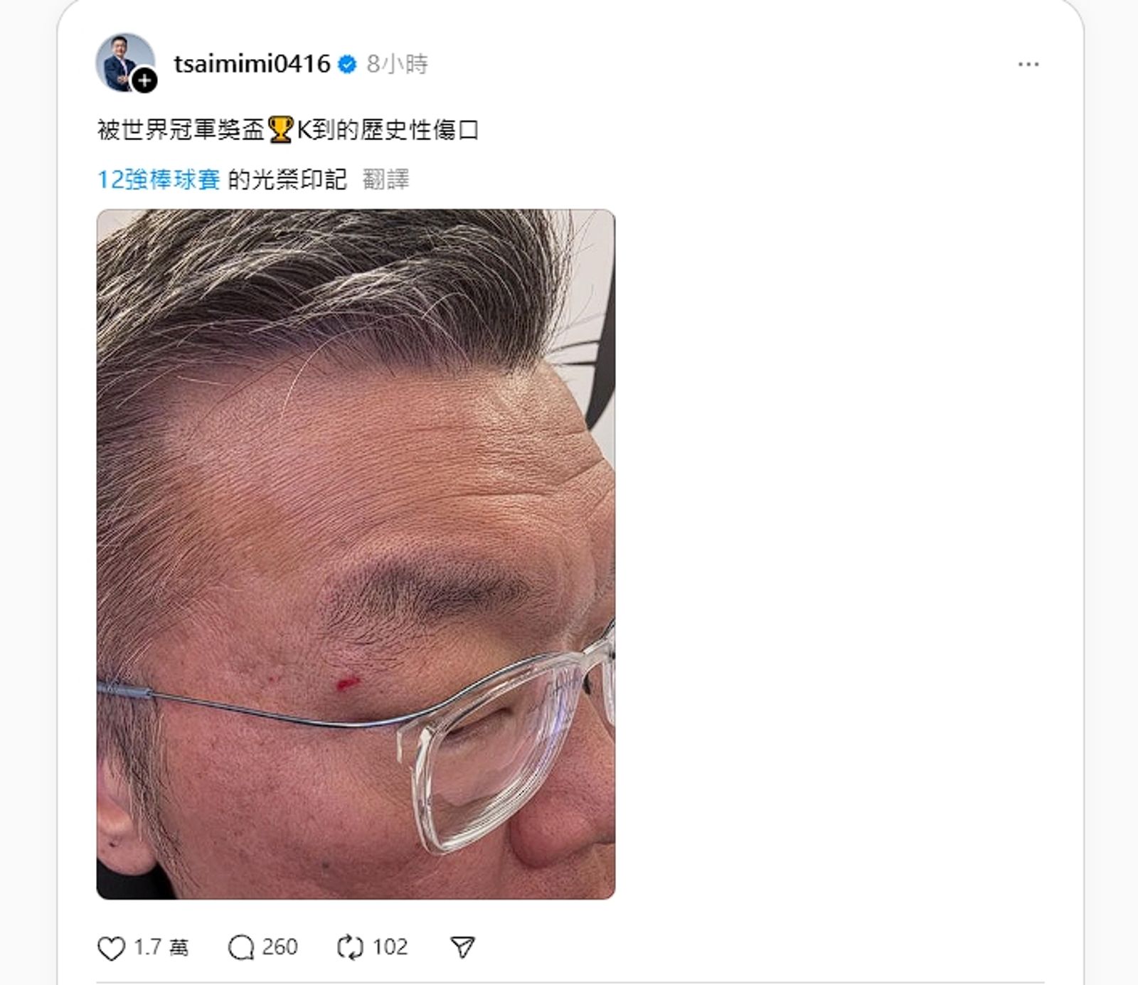 蔡其昌今分享被冠軍獎盃K到的「光榮印記」。（圖／翻設自Threads）