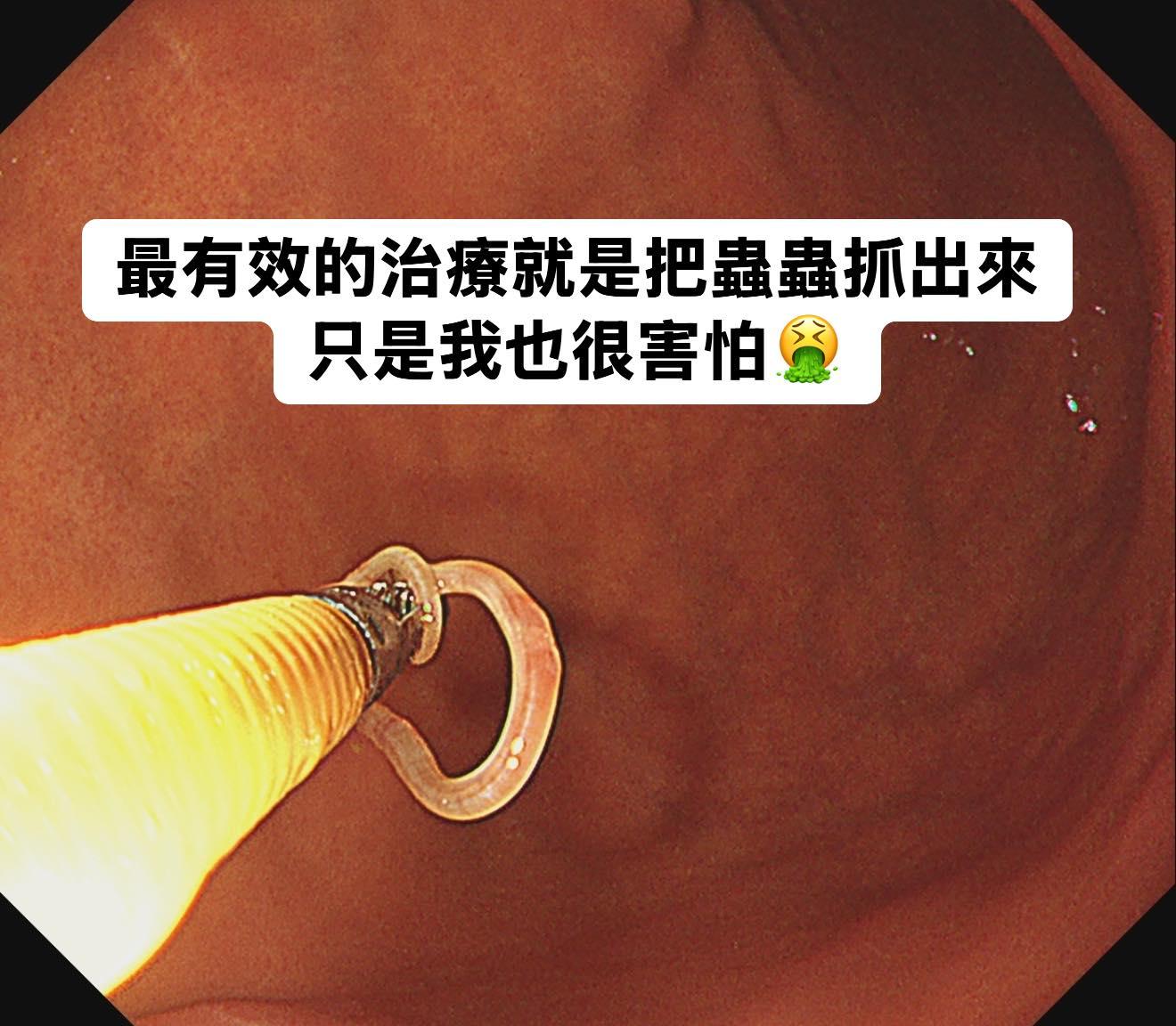 對付「海獸胃線蟲」的最佳治療方式就是勇敢把它夾出來。(圖/翻攝自「胰臟醫師 林相宏 禾馨民權內科診所」臉書)