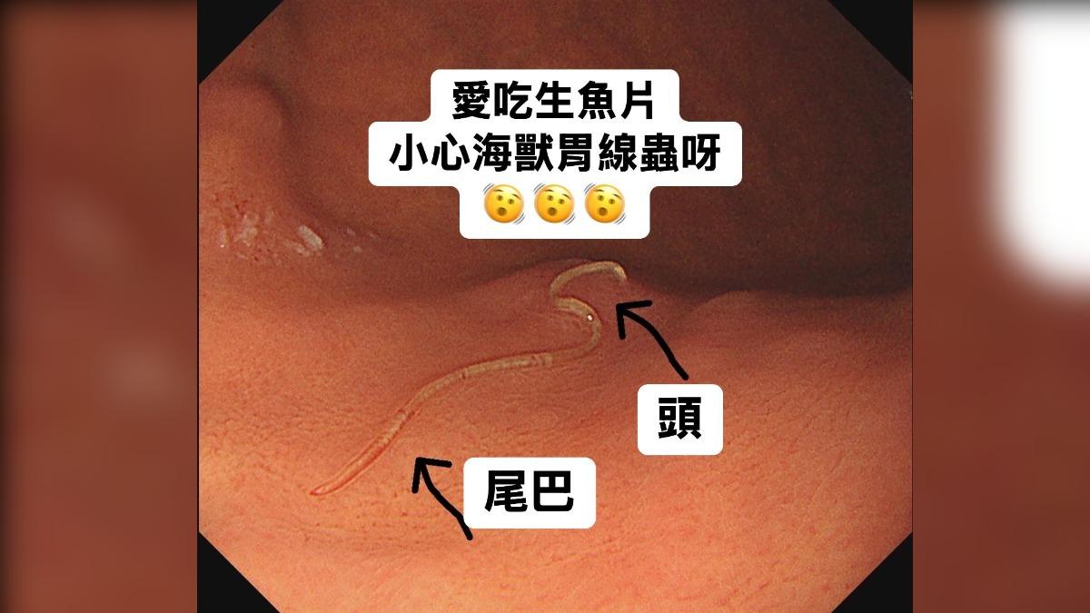 她胃不舒服拖數月!一檢查「5公分巨蟲鑽胃」 醫搖頭:死路一條