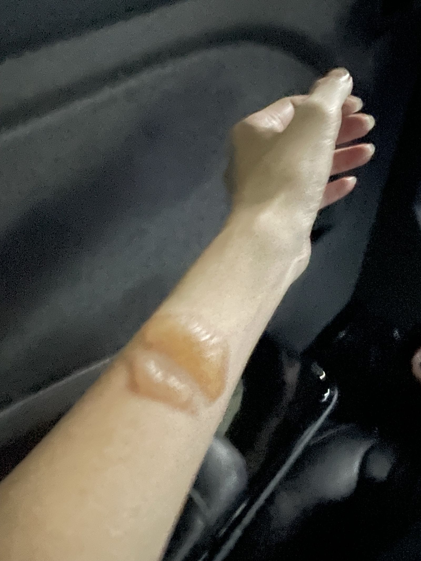 邱妻手臂遭安全氣囊爆開的高熱灼傷。(圖/讀者提供)